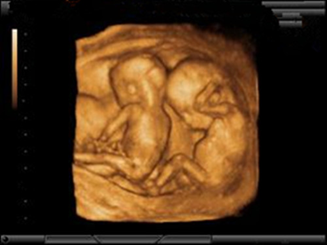 胎児超音波1
