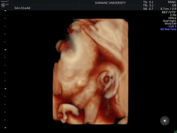 胎児超音波2