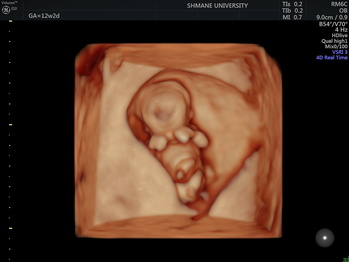 胎児超音波3