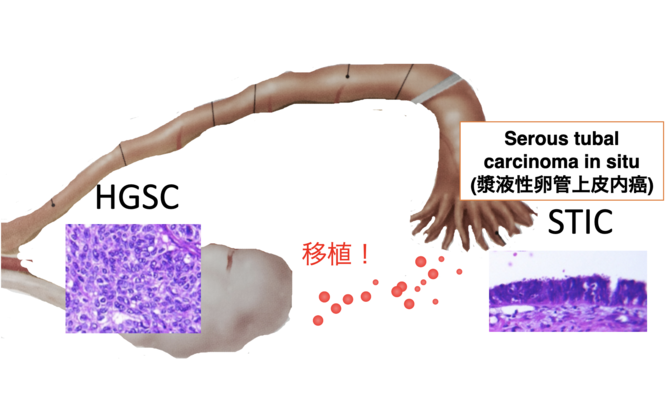 図１　高異型漿液性癌(HGSC)の卵管采起源説