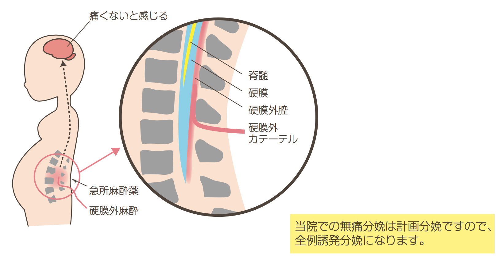 無痛分娩のしくみ